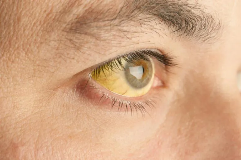 yellow-fever